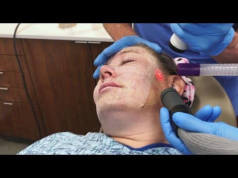 Full Face Fractional CO2 Laser Resurfacing for Wrinkles and Skin Tightening