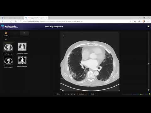 TEAM FRCR 2B Viva Practice Session (Chest Module Revision). 9th Jan, 2021.