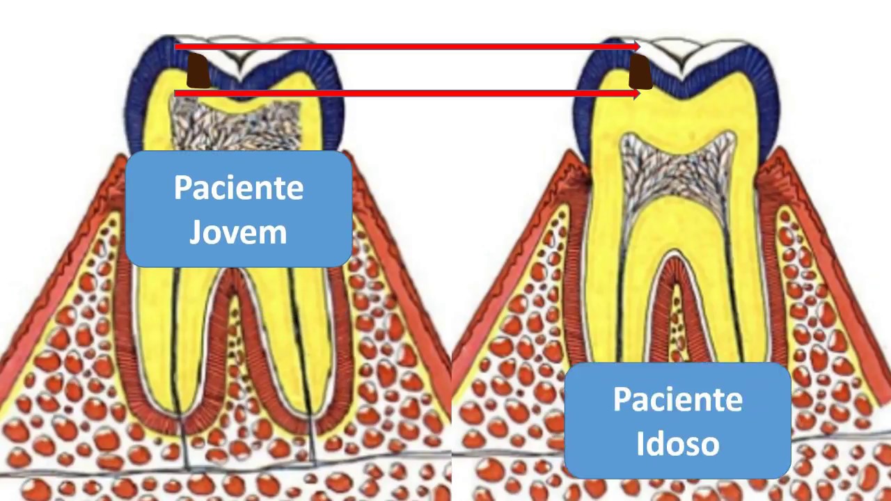 4ª Aula Dentística - Proteção do complexo dentinopulpar