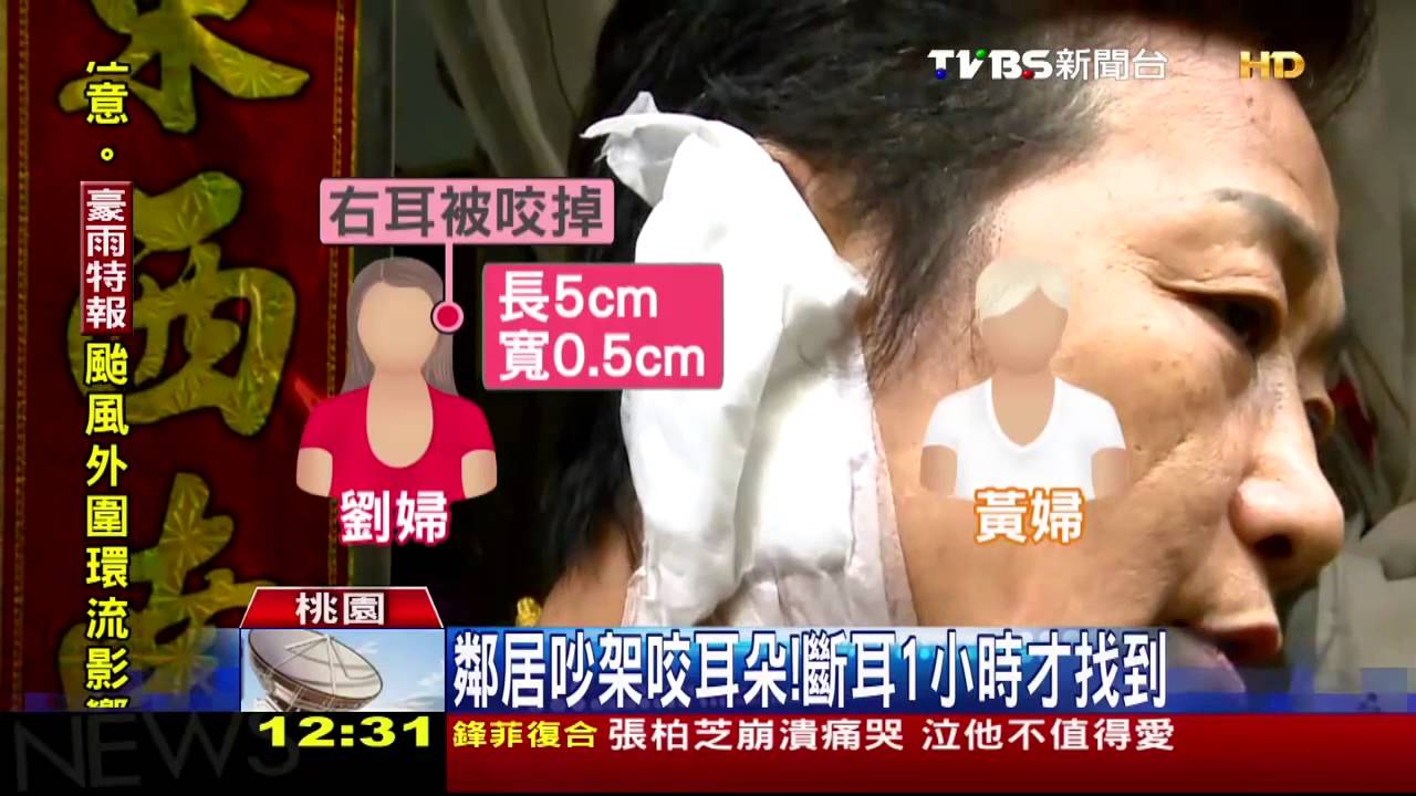 真的「咬耳朵」! 吵架咬斷鄰居右耳