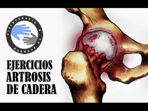 Dolor de espalda con escoliosis torácica Producto de la flexión para el precio conjunta