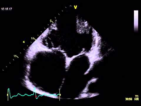 2 ATRIA , 2 VALVES, but only 1 VENTRICLE