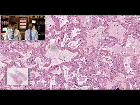 Pattern 1 - Acute Lung Injury