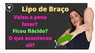 Lipoaspiração de Braço: Fica flácido Resultado antes e depois