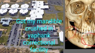 Got my jaw broke in the Yaphank correctional facility. You win some you lose some