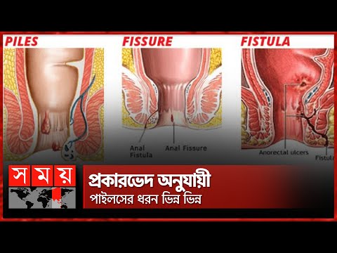 পাইলস, ফিসার ও ফিস্টুলার মধ্যে পার্থক্য কী? | Piles | Fissure | Fistula | Somoy TV