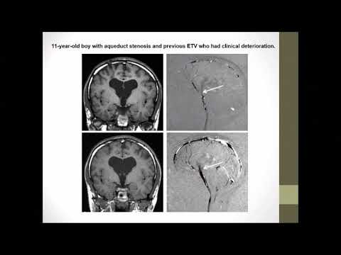 CSF Dynamics following ETV  - a thought provoking lecture
