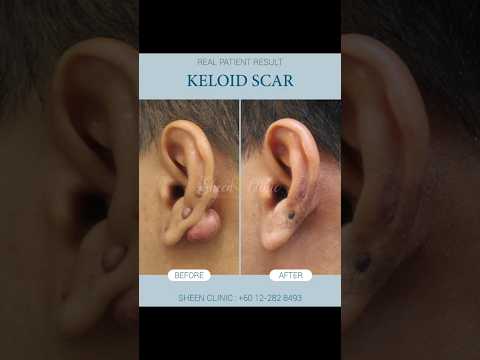 Keloid Scar Treatment | Flatten & Fade Raised Scars