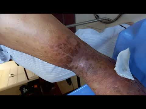 Hoại Tử Do Tiểu Đường, nằm lâu ngày