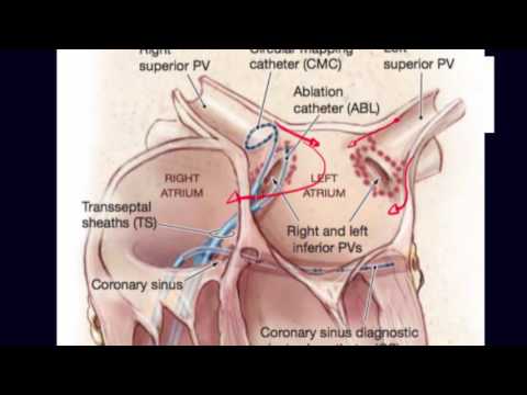 Role of pulmonary veins in initiation of atrial fibrillation