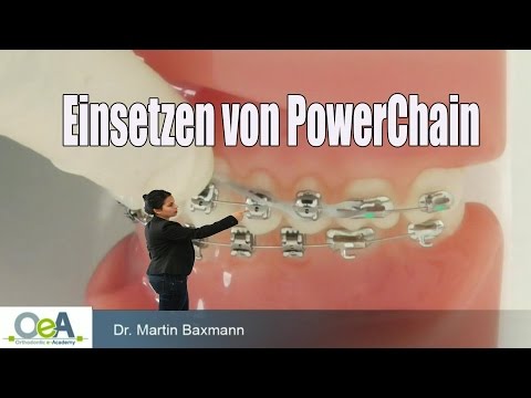 Einsetzen von PowerChain - space closure with POWERCHAIN I OeA