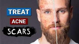How to GET RID of ACNE SCARS & MARKS??
