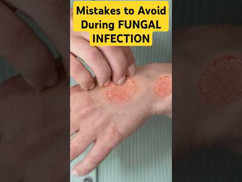 बार बार Fungal Infections क्यूँ होता है? #fungal #infection #shorts #dadumedicalcentre