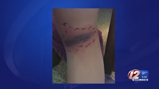 5 Year Old Got Bit By Black Widow Spider