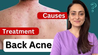 Back acne | Why does it happen | How to treat | Dermatologist
