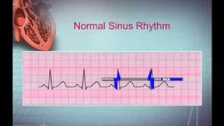 Intro EKG Interpretation Part 1