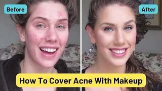 Foundation Routine For Acne! Cover Pimples, Scars, Cystic Acne, Blackheads &amp; Oil | Cassandra Bankson