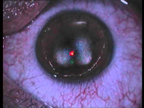 Affronti il pacco con olio di cocco e carbonato di sodio Laser che si solleva di un occhio