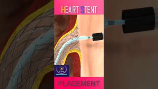 Download lagu Heart Stent Placement #shorts mp3 Download lagu Heart Stent Placement #shorts mp3