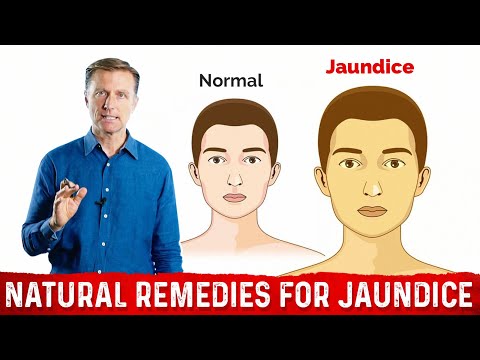 What is Jaundice? – Causes & Treatment Covered by Dr.Berg