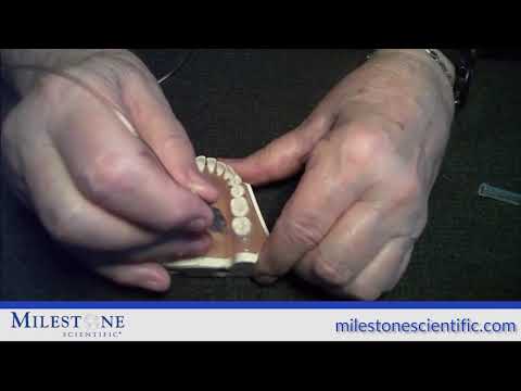 MLSS - Crestal Injection with the STA System (Wand STA)