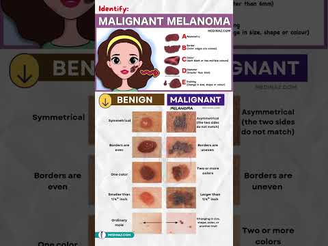 How to Identify Melanoma | Skin Cancer Early Signs