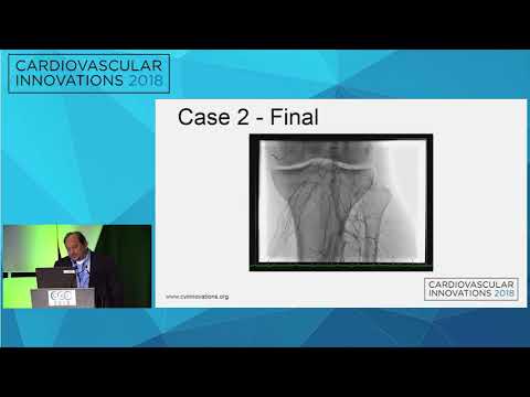 CVI2018 Session: Innovative approaches to treat SFA, radial versus pedal? - Ian Cawich, MD