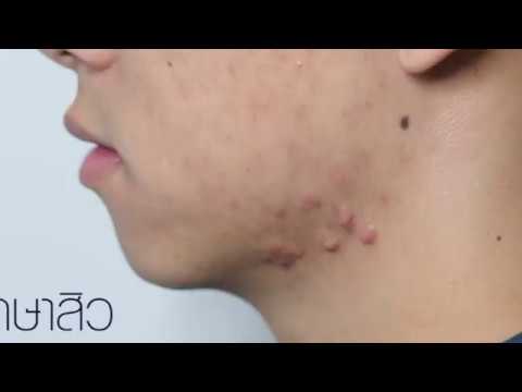 รักษาสิวคีลอยด์ เป็นมานานเรื้อรัง Dr.Chen Clinic รักษาสิวคีลอยด์ เป็นมานานเรื้อรัง Dr.Chen Clinic