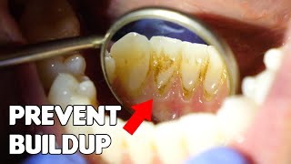 How to Prevent Buildup on Bottom Front Teeth