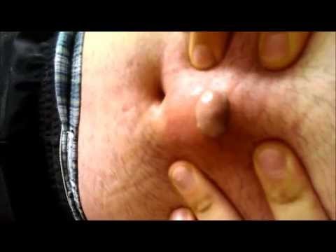Infected Ingrown Hair Gross Kansas City Comic Con