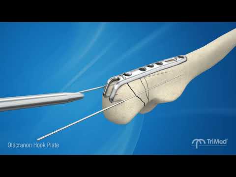 TriMed Olecranon Hook Plate - Rock Solid fixation for comminuted olecranon fractures