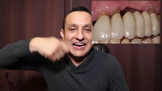 Implantes Dentales que dan mal Aliento cuales son y por que