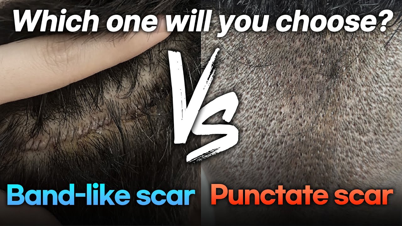 FUE vs FUT Hair Transplant｜Which is better for you?