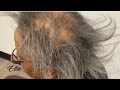Short Quick Weave Gray Hair Weave Alopecia Regrowth