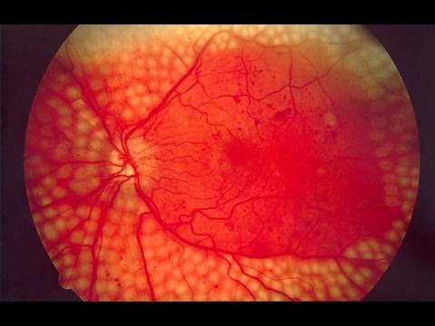 Könnte es der Zucker im Blut Von Wassermelone steigt der Blutzucker