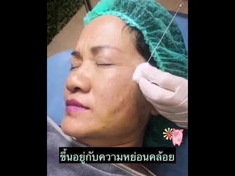 ร้อยไหม หน้าเรียว