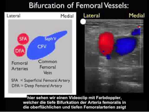 Anleitung: Fallstudie – Ermittlung einer tiefen Venenthrombose mit Ultraschall – Teil 1