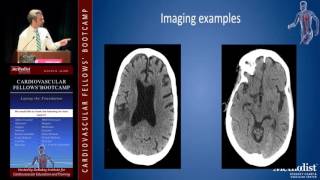 Download Lagu Diagnosis and Medical Management of Stroke (John Volpi, MD) Thumbnail