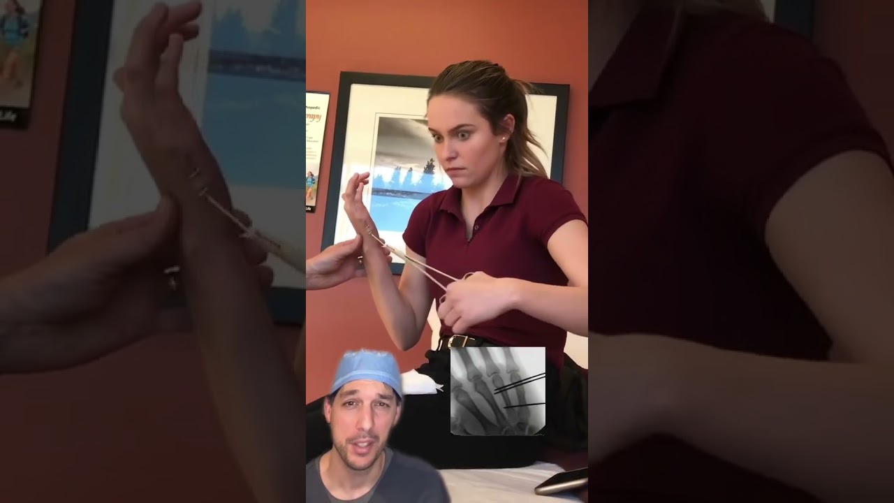 Taking “do it yourself” to a whole ‘nother level! #Pin #Surgery #Fracture #Medical #Nurse #Hand