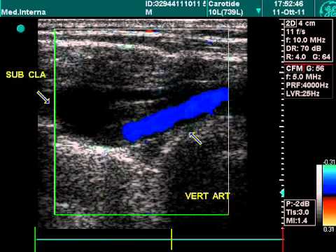 Vertebral Artery, Doppler Echography