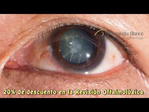 Cataratas y Cirugía