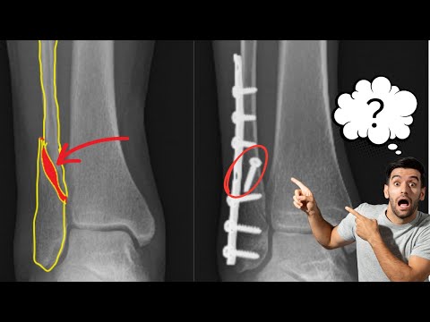 How Surgeons Fix This Ankle Fracture!