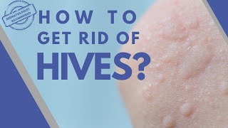 How to get rid of hives I Dermatologist Guide