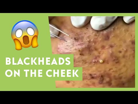 Blackheads and Whiteheads removal on the cheek 10