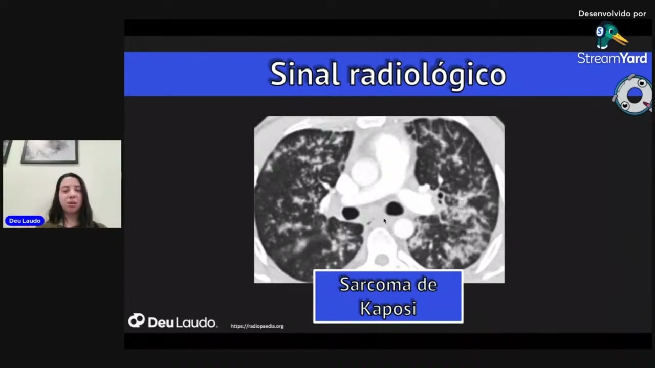 NÓDULOS PULMONARES NA TC DE TÓRAX: COMO EU AVALIO