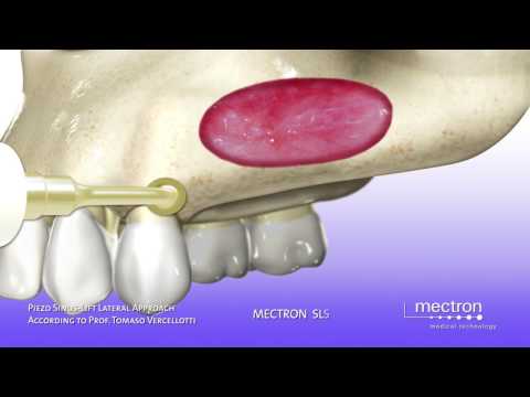 PIEZOSURGERY - ANIMATION - Sinus lift with lateral approach - Sinus Lift Technique (Vercellotti)