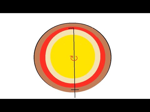 Capsular Fornix Hydrodissection: A Better Way to Hydrodissect?