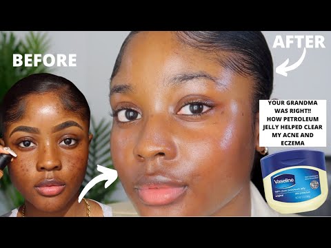 HOW VASELINE HELPED CLEAR MY ACNE AND EZCEMA FASTER!! | KAISERCOBY