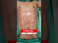 6 Pack Abs Surgery Six Pack Abs Surgery Result Liposuction Cost Shortvideo Shots