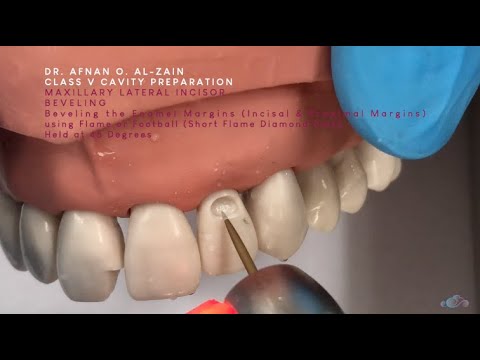 Class V Cavity Preparation For Fomposite On A Maxillary Lateral Incisor (#22) - Pre-Clincal Dentistry